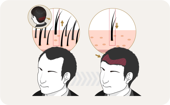 自毛植毛とは？