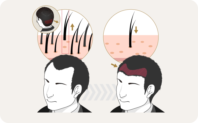 自毛植毛とは？