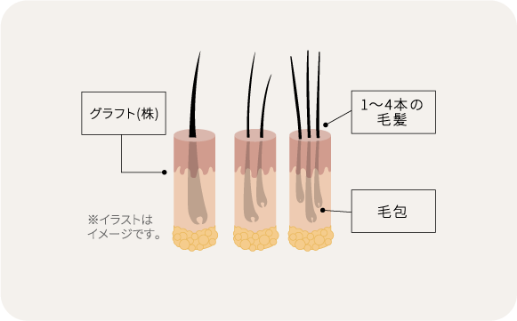グラフトとは？