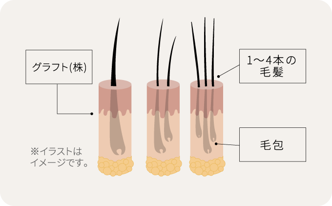 グラフトとは？